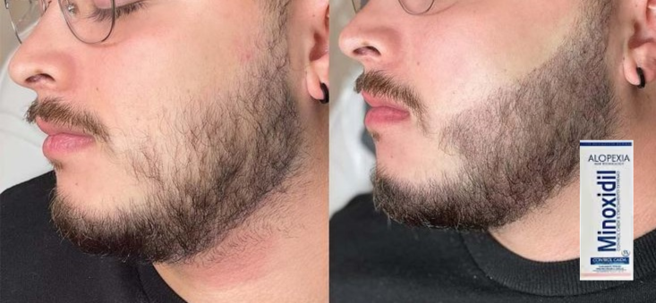 Tratamiento capilar para una barba Varonil